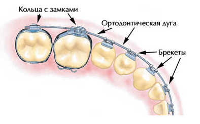 ustaonvka-breketov